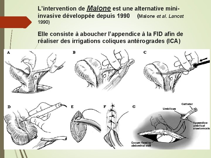 L’intervention de Malone est une alternative miniinvasive développée depuis 1990 (Malone et al. Lancet