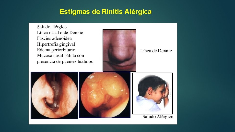 Estigmas de Rinitis Alérgica 