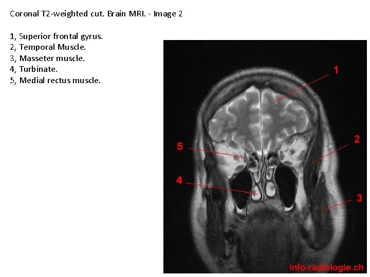 Coronal T 2 -weighted cut. Brain MRI. - Image 2 1, Superior frontal gyrus.