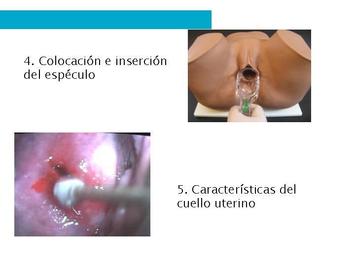 4. Colocación e inserción del espéculo 5. Características del cuello uterino 