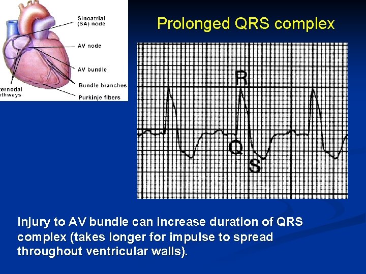 Prolonged QRS complex Injury to AV bundle can increase duration of QRS complex (takes