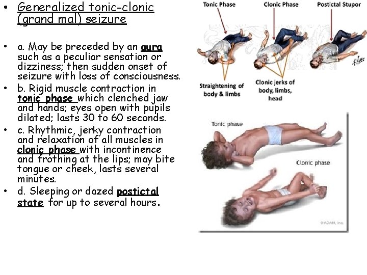  • Generalized tonic-clonic (grand mal) seizure • a. May be preceded by an