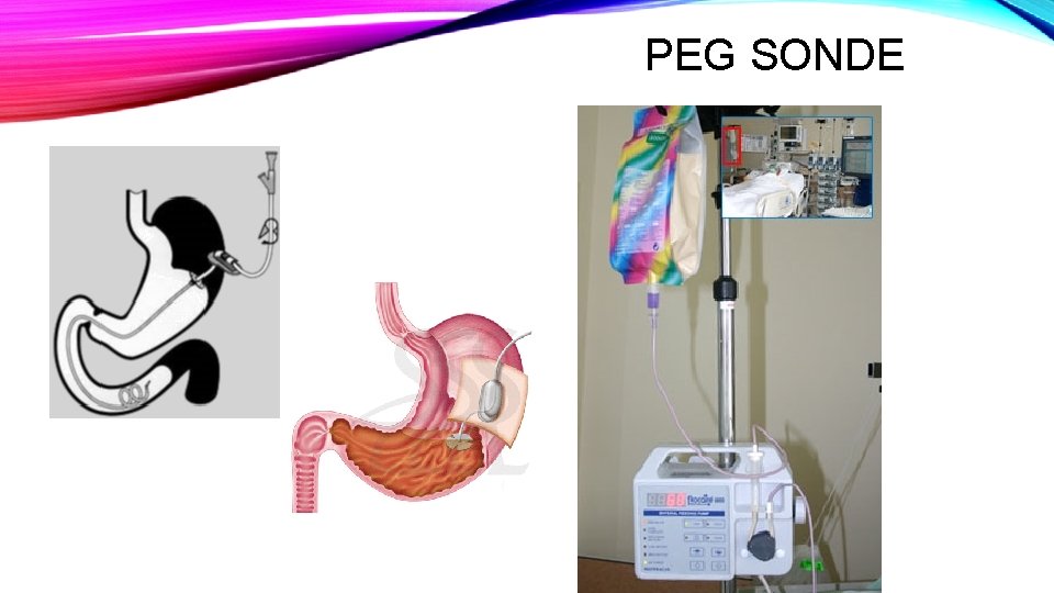 PEG SONDE PEG SONDE