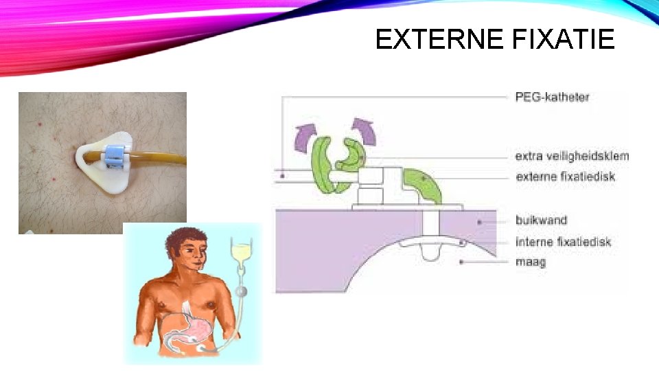 EXTERNE FIXATIE EXTERNE FIXATIE