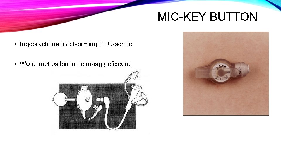 MIC-KEY BUTTON • Ingebracht na fistelvorming PEG-sonde • Wordt met ballon in de maag MIC-KEY BUTTON • Ingebracht na fistelvorming PEG-sonde • Wordt met ballon in de maag