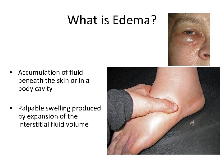 What is Edema? • Accumulation of fluid beneath the skin or in a body