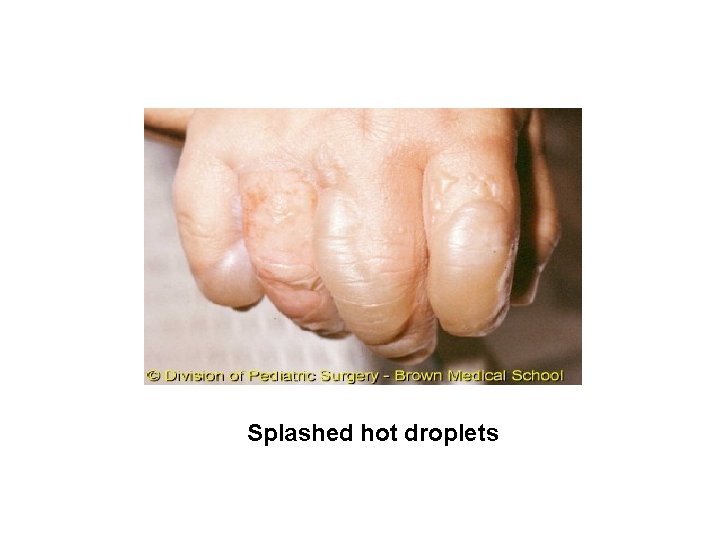 Splashed hot droplets 