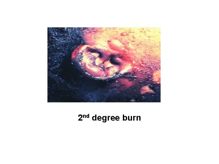 2 nd degree burn 