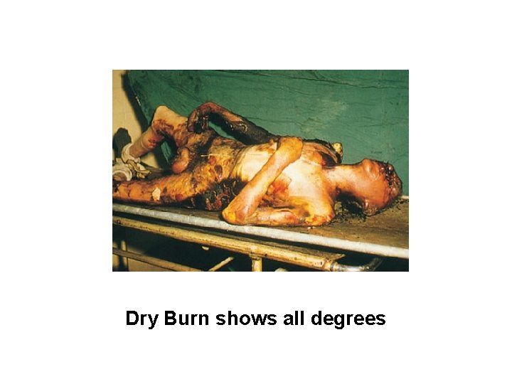 Dry Burn shows all degrees 