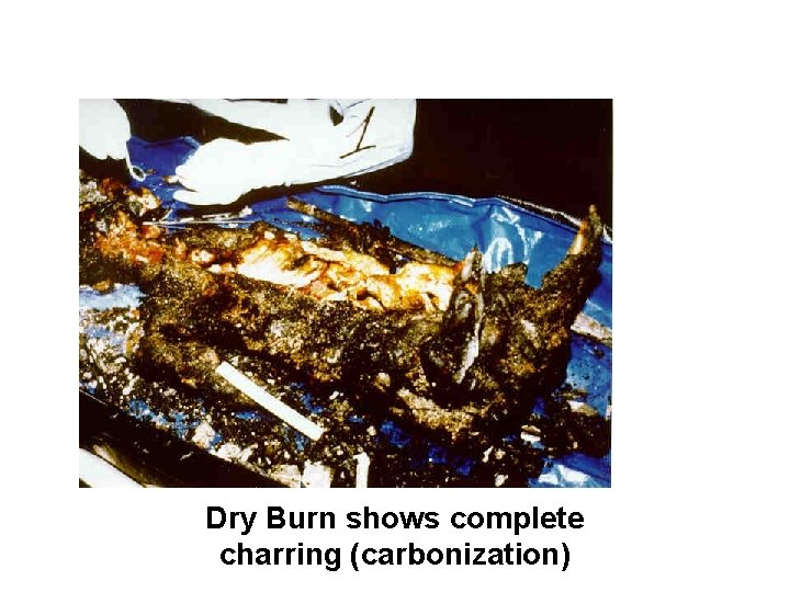 Dry Burn shows complete charring (carbonization) 