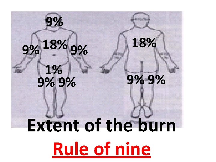 9% 18% 9% 9% 18% 1% 9% 9% Extent of the burn Rule of