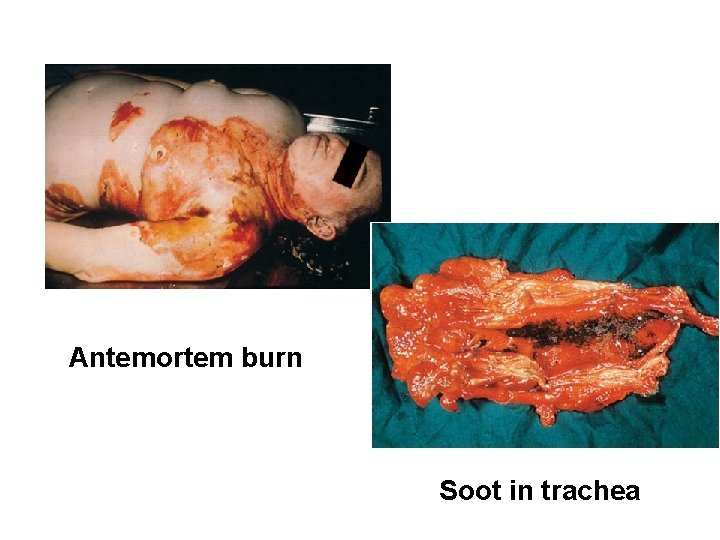 Antemortem burn Soot in trachea 