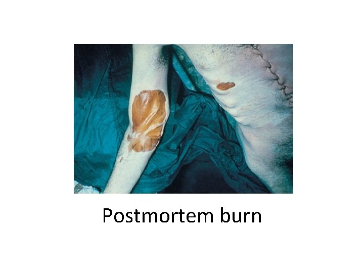 Postmortem burn 
