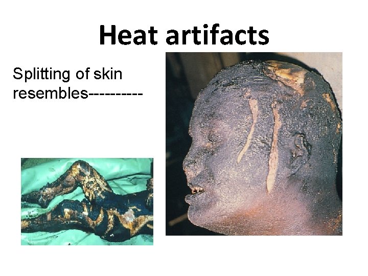 Heat artifacts Splitting of skin resembles----- 