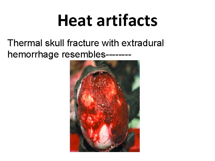 Heat artifacts Thermal skull fracture with extradural hemorrhage resembles---- 