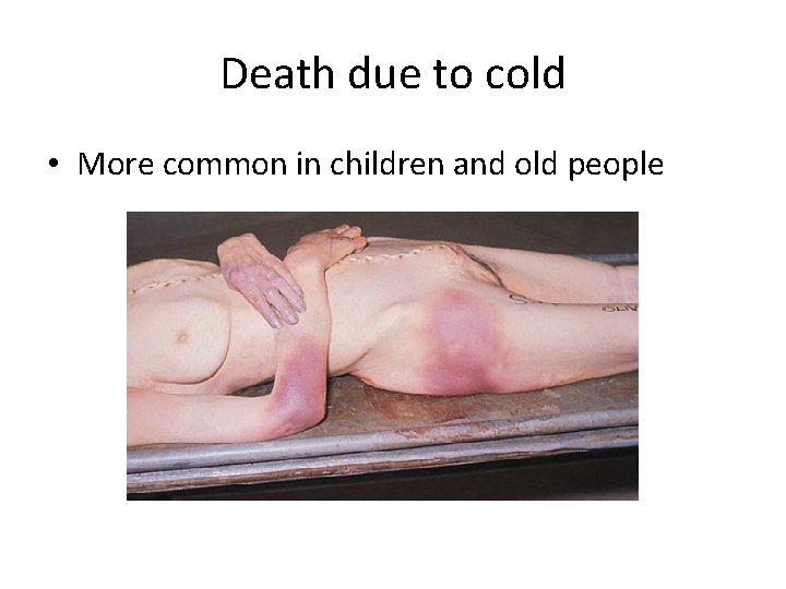 Death due to cold • More common in children and old people 