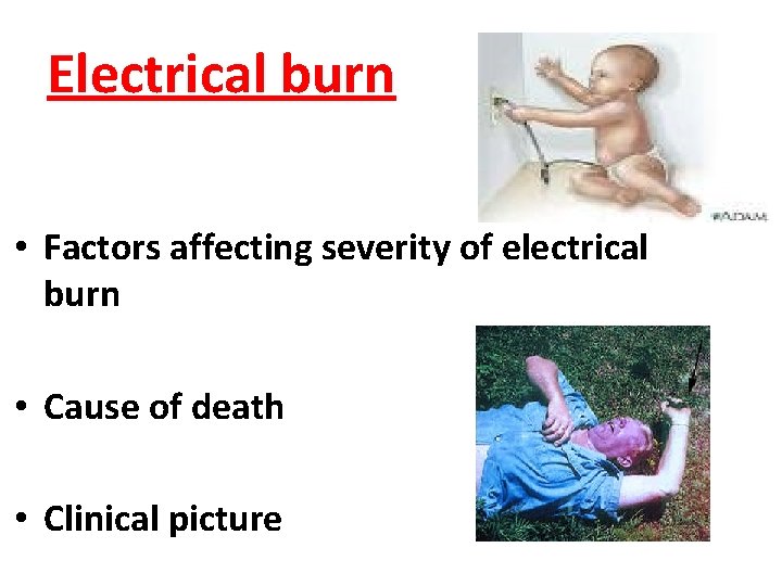 Electrical burn • Factors affecting severity of electrical burn • Cause of death •