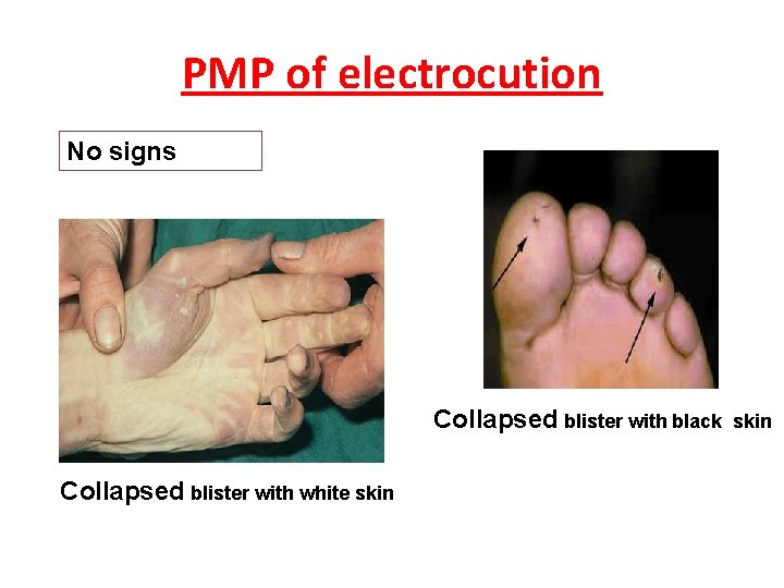 PMP of electrocution No signs Collapsed blister with black Collapsed blister with white skin