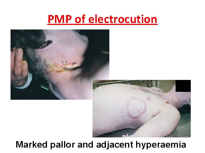 PMP of electrocution Marked pallor and adjacent hyperaemia 