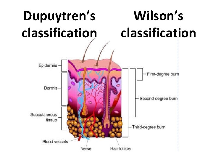Dupuytren’s classification Wilson’s classification 