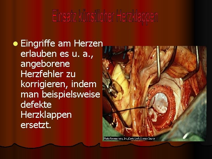 l Eingriffe am Herzen erlauben es u. a. , angeborene Herzfehler zu korrigieren, indem