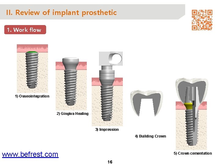 II. Review of implant prosthetic 1. Work flow 1) Osseointegration 2) Gingiva Healing 3)