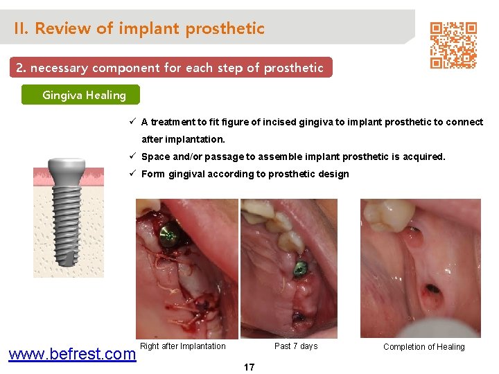 II. Review of implant prosthetic 2. necessary component for each step of prosthetic Gingiva