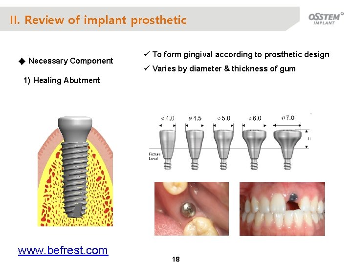 II. Review of implant prosthetic ◆ Necessary Component ü To form gingival according to