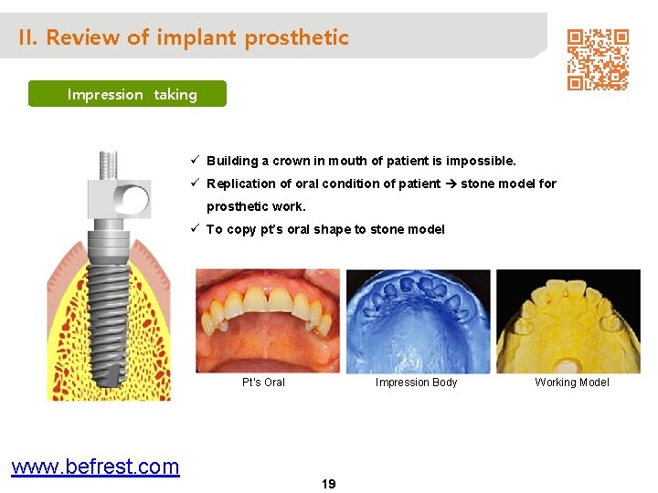 II. Review of implant prosthetic Impression taking ü Building a crown in mouth of