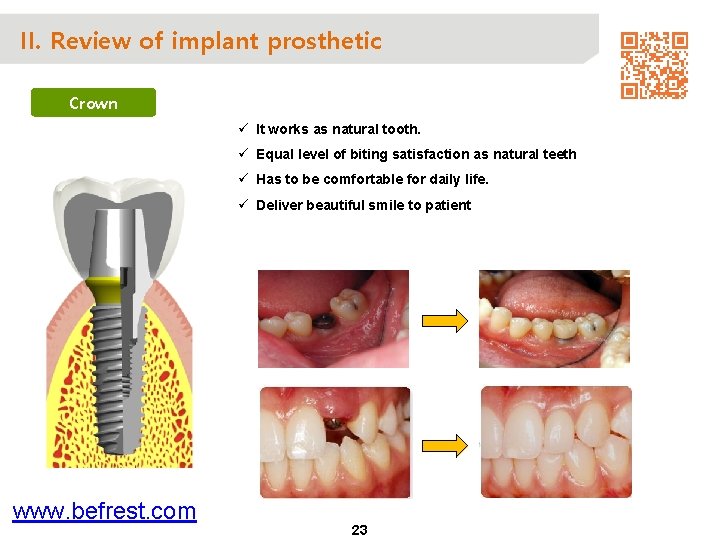 II. Review of implant prosthetic Crown ü It works as natural tooth. ü Equal