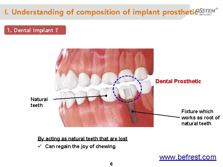 I. Understanding of composition of implant prosthetic 1. Dental Implant ? Dental Prosthetic Natural