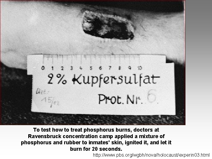 To test how to treat phosphorus burns, doctors at Ravensbruck concentration camp applied a