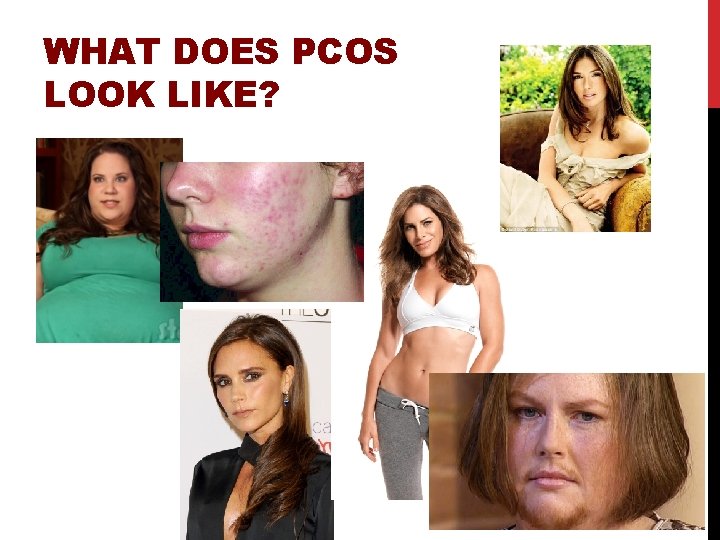 WHAT DOES PCOS LOOK LIKE? 