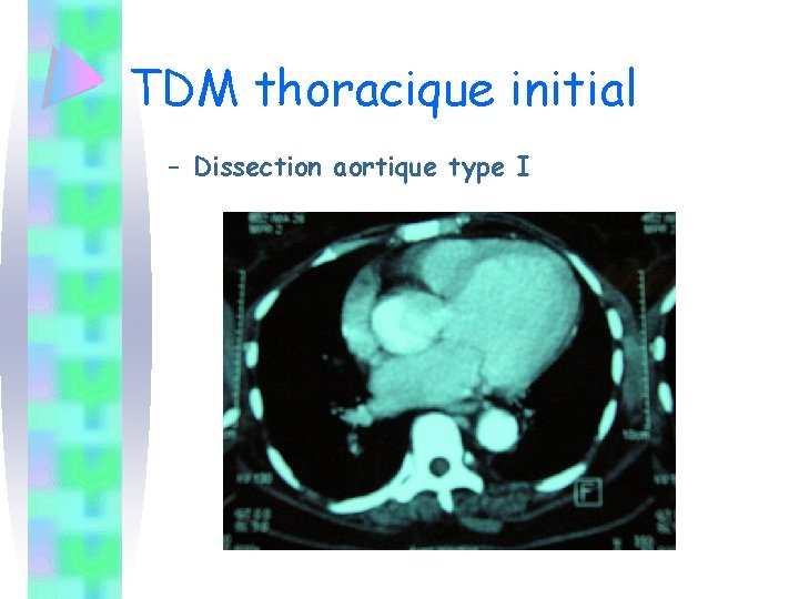 TDM thoracique initial – Dissection aortique type I 