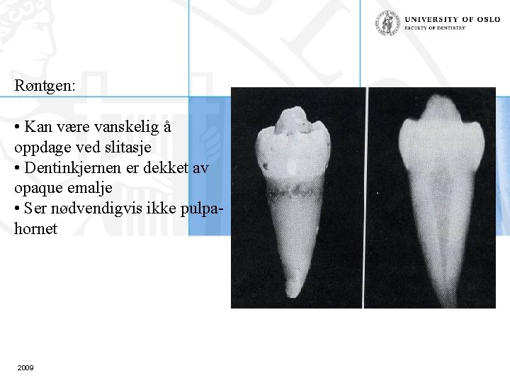 Røntgen: • Kan være vanskelig å oppdage ved slitasje • Dentinkjernen er dekket av