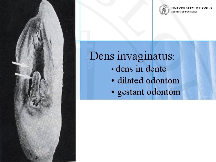 Dens invaginatus: • dens in dente • dilated odontom • gestant odontom 2009 