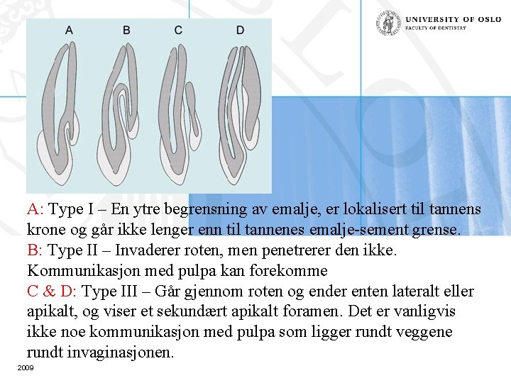 A: Type I – En ytre begrensning av emalje, er lokalisert til tannens krone