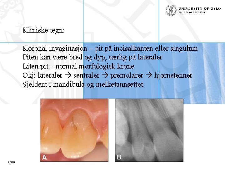 Kliniske tegn: Koronal invaginasjon – pit på incisalkanten eller singulum Piten kan være bred