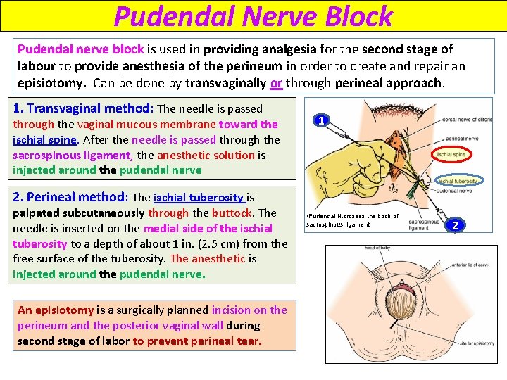 Pudendal Nerve Block Pudendal nerve block is used in providing analgesia for the second