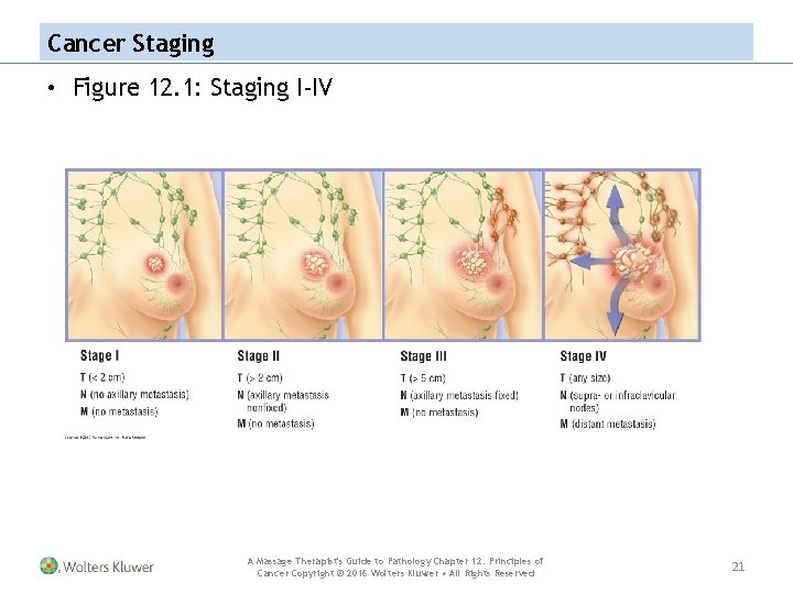 Cancer Staging • Figure 12. 1: Staging I-IV A Massage Therapist's Guide to Pathology
