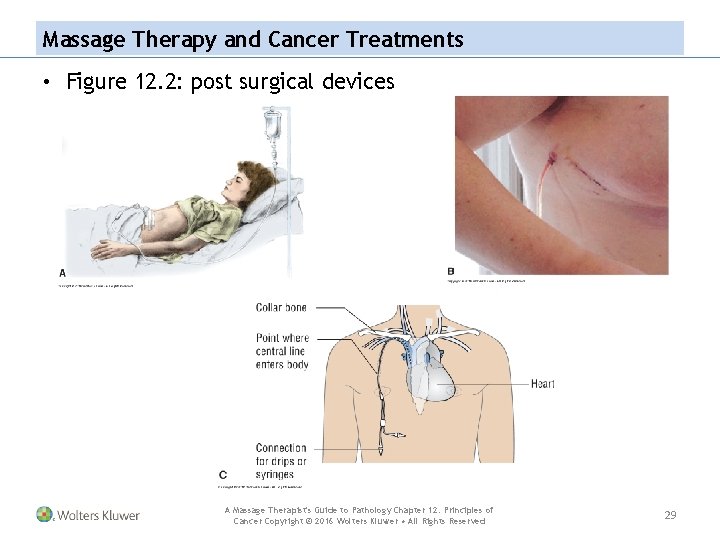 Massage Therapy and Cancer Treatments • Figure 12. 2: post surgical devices A Massage