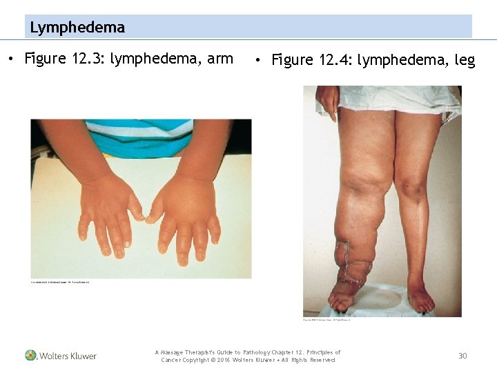 Lymphedema • Figure 12. 3: lymphedema, arm • Figure 12. 4: lymphedema, leg A