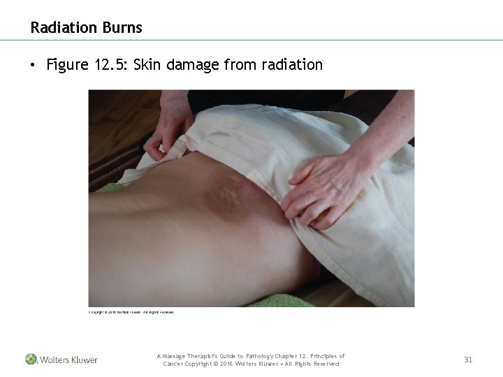 Radiation Burns • Figure 12. 5: Skin damage from radiation A Massage Therapist's Guide