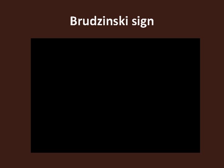 Brudzinski sign 