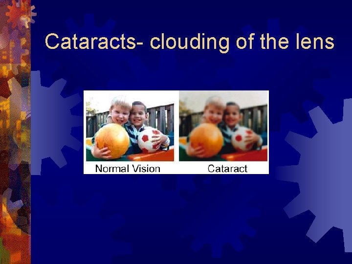 Cataracts- clouding of the lens 