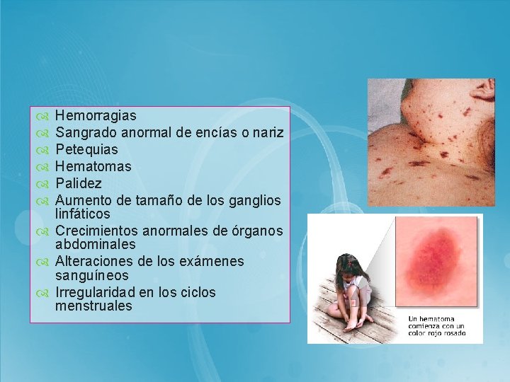  Hemorragias Sangrado anormal de encías o nariz Petequias Hematomas Palidez Aumento de tamaño