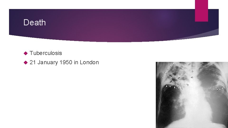 Death Tuberculosis 21 January 1950 in London 
