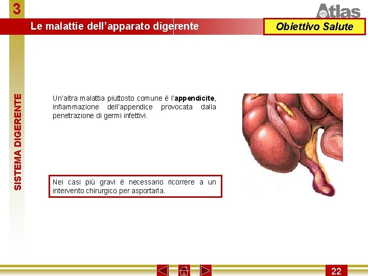 3 SISTEMA DIGERENTE Le malattie dell’apparato digerente Obiettivo Salute Un’altra malattia piuttosto comune è