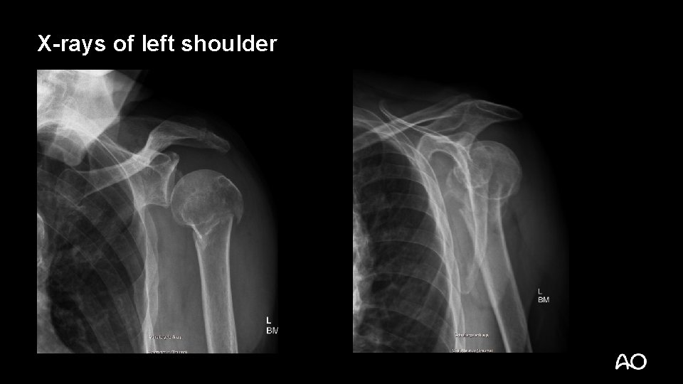 X-rays of left shoulder 