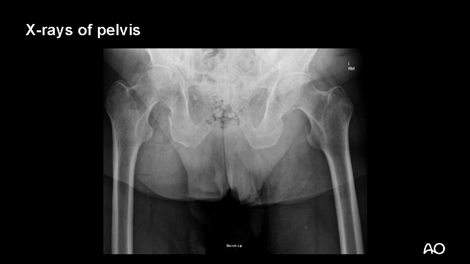X-rays of pelvis 